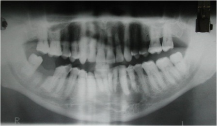 Figure 2: Photograph showing Orthopantomogram revealing a well defined multilocular radiolucent lesion extending from left mandibular first premolar to right side canine.